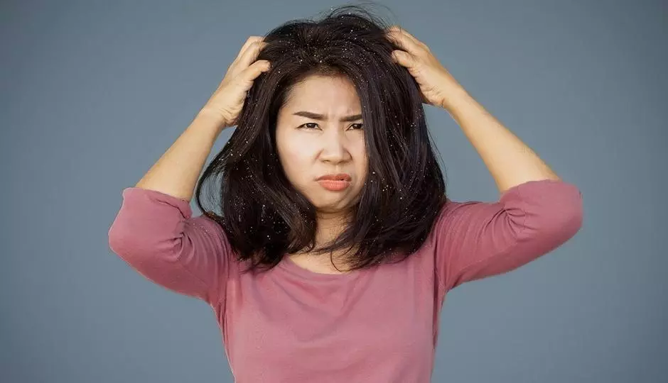 Is There a Link between Seborrhea Dermatitis and Hair Loss?