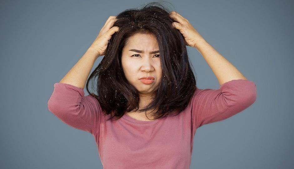 Is There a Link between Seborrhea Dermatitis and Hair Loss?