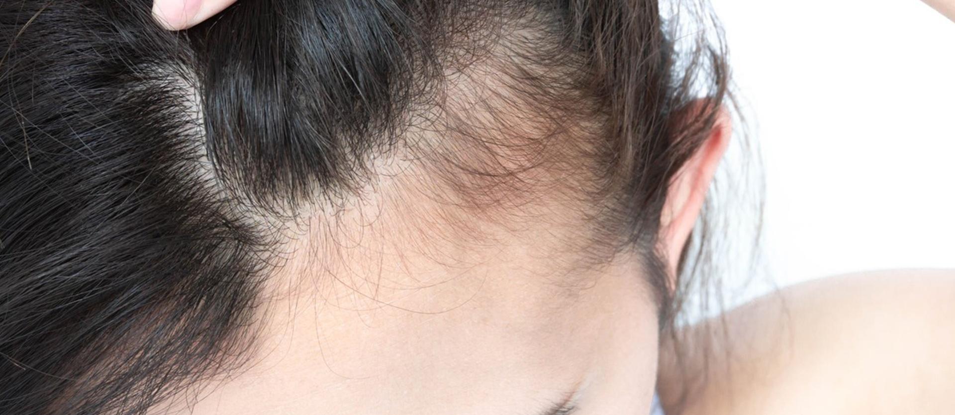 Frontal Fibrosing Alopecia, What Is It?