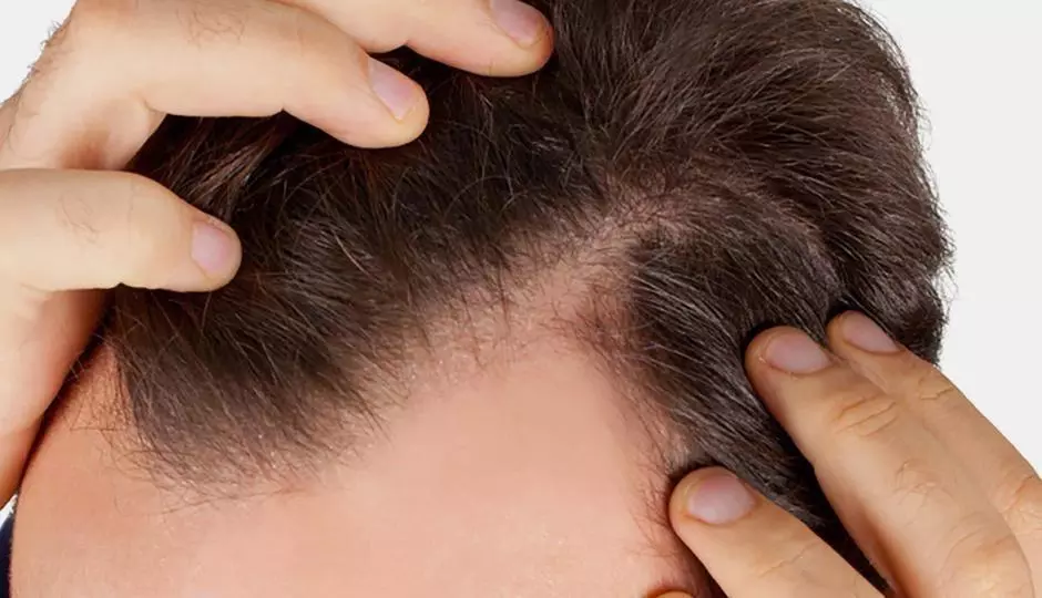 7 Hair Loss Culprits