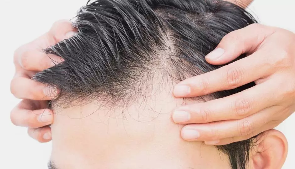 Causes of Men’s Hair Loss