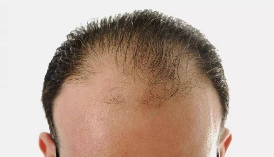 Men and Hair Loss: Myths and Most Common Forms of Hair Loss
