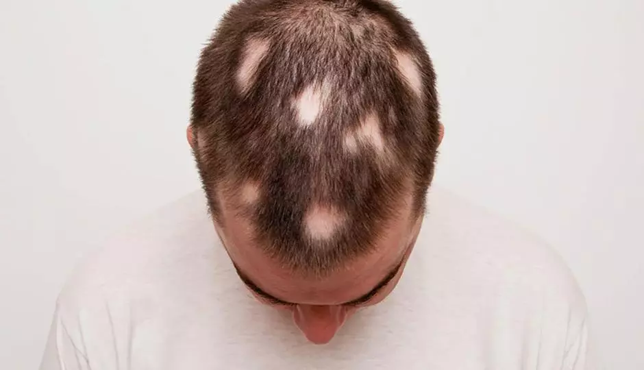 child with hair loss