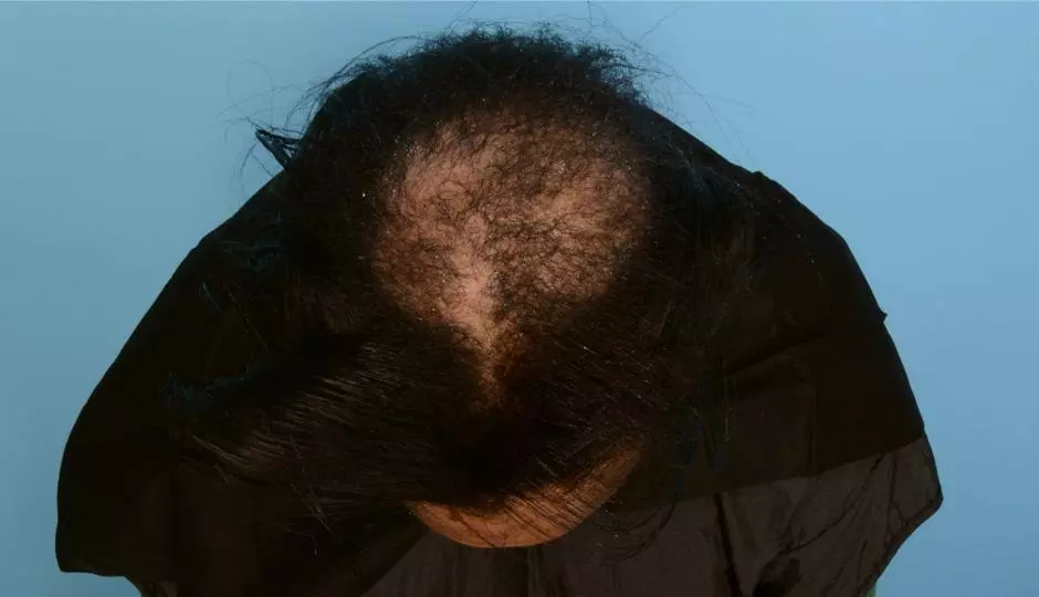 Effects of Cicatricial Centrifugal Alopecia