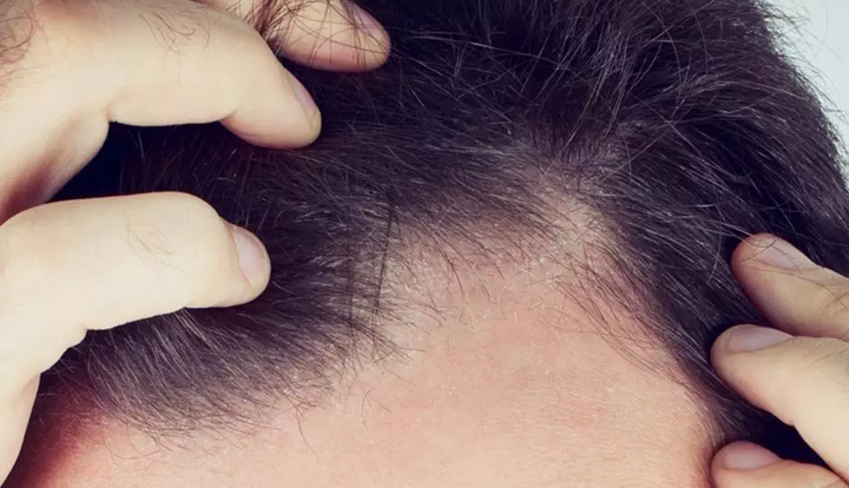 Man with symptoms of Frontal Fibrosing Alopecia