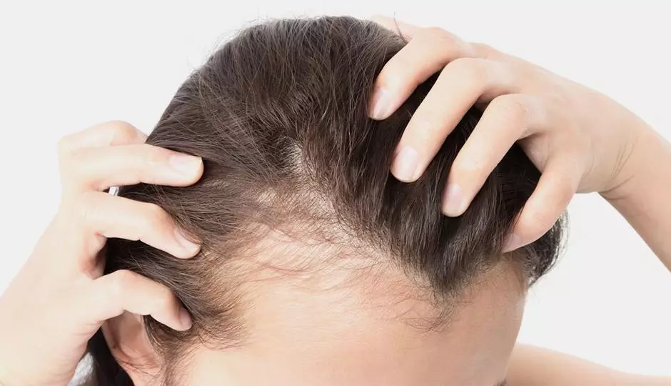 5 Reasons Women Experience Hair Loss