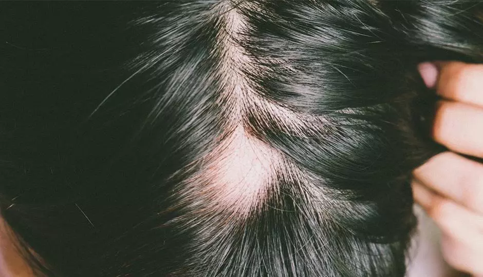 Facts About Alopecia Areata 