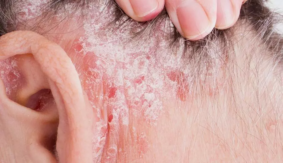 How to Treat Psoriasis of the Scalp  