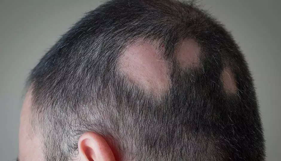 Understanding Alopecia Areata 