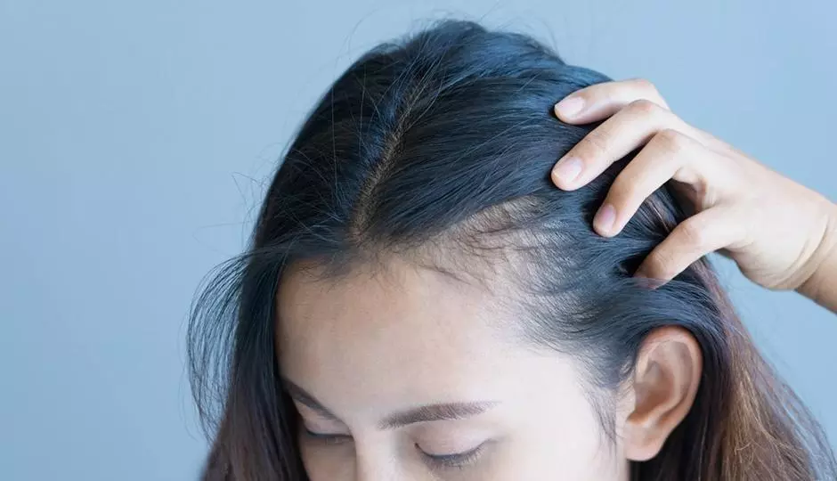 5 Facts Regarding Female Hair Loss