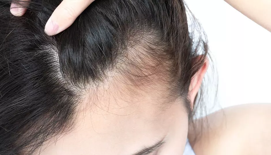 The Differences Between Frontal Fibrosing Alopecia and Traction Alopecia