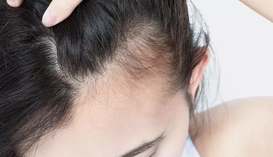 Frontal Fibrosing Alopecia, What Is It?