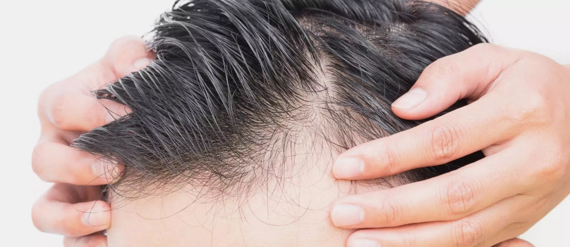 Causes of Men’s Hair Loss