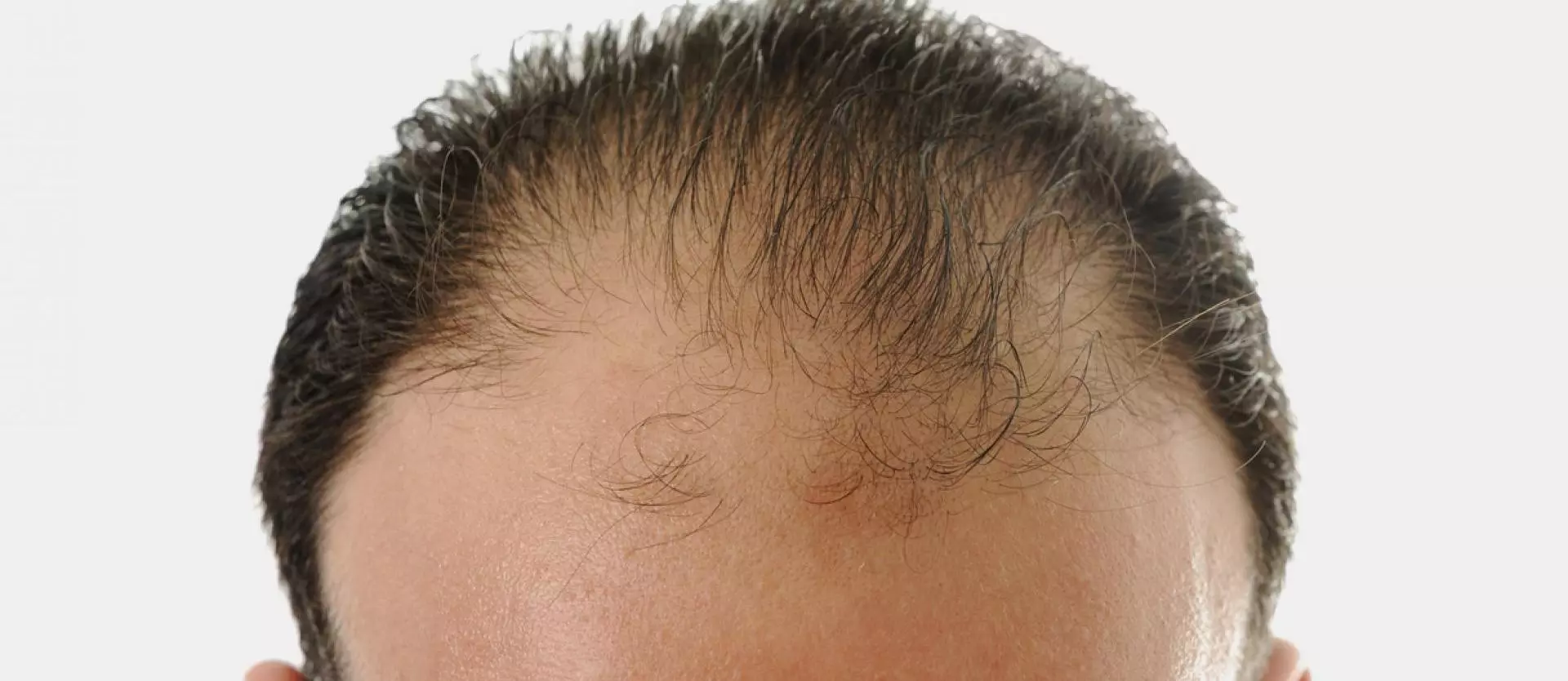 Men and Hair Loss: Myths and Most Common Forms of Hair Loss