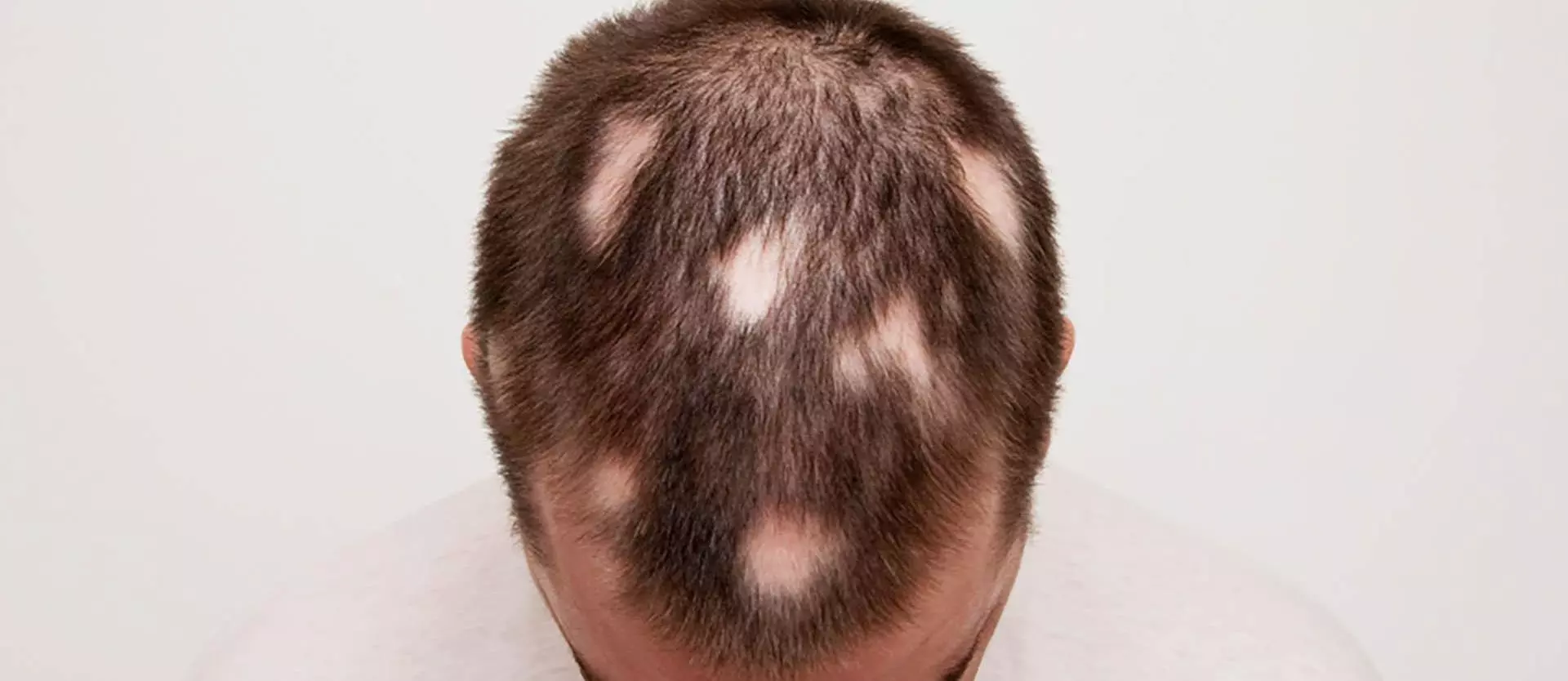 child with hair loss
