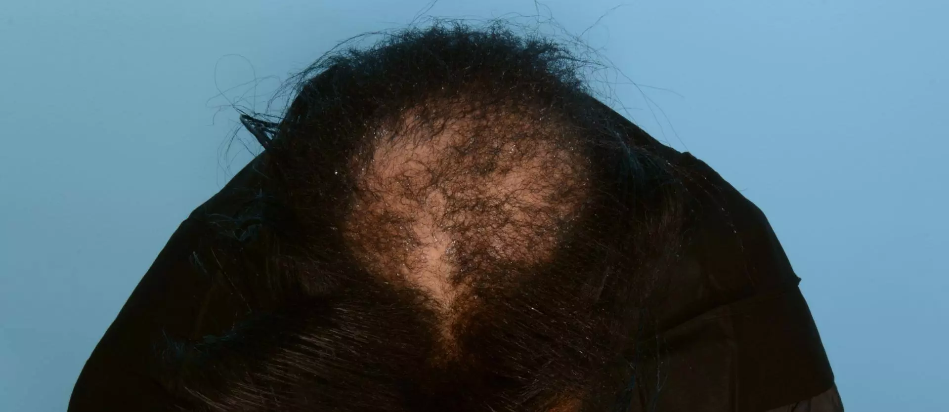 Effects of Cicatricial Centrifugal Alopecia
