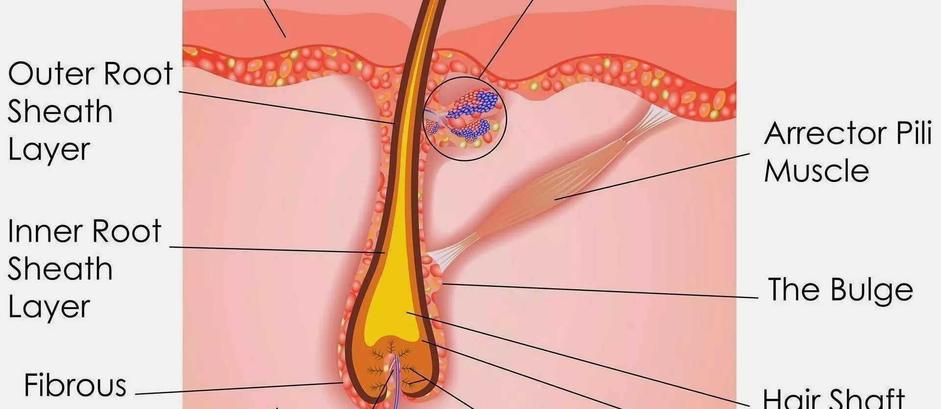 DHT causes hair loss