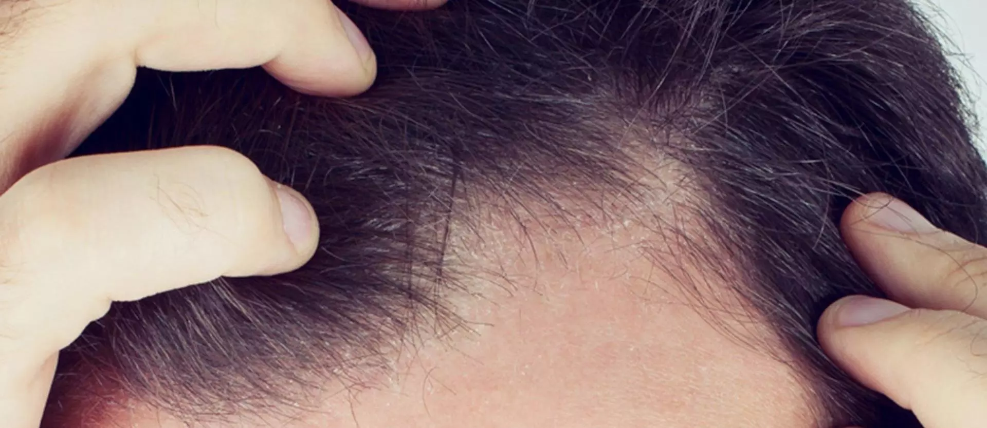 Man with symptoms of Frontal Fibrosing Alopecia
