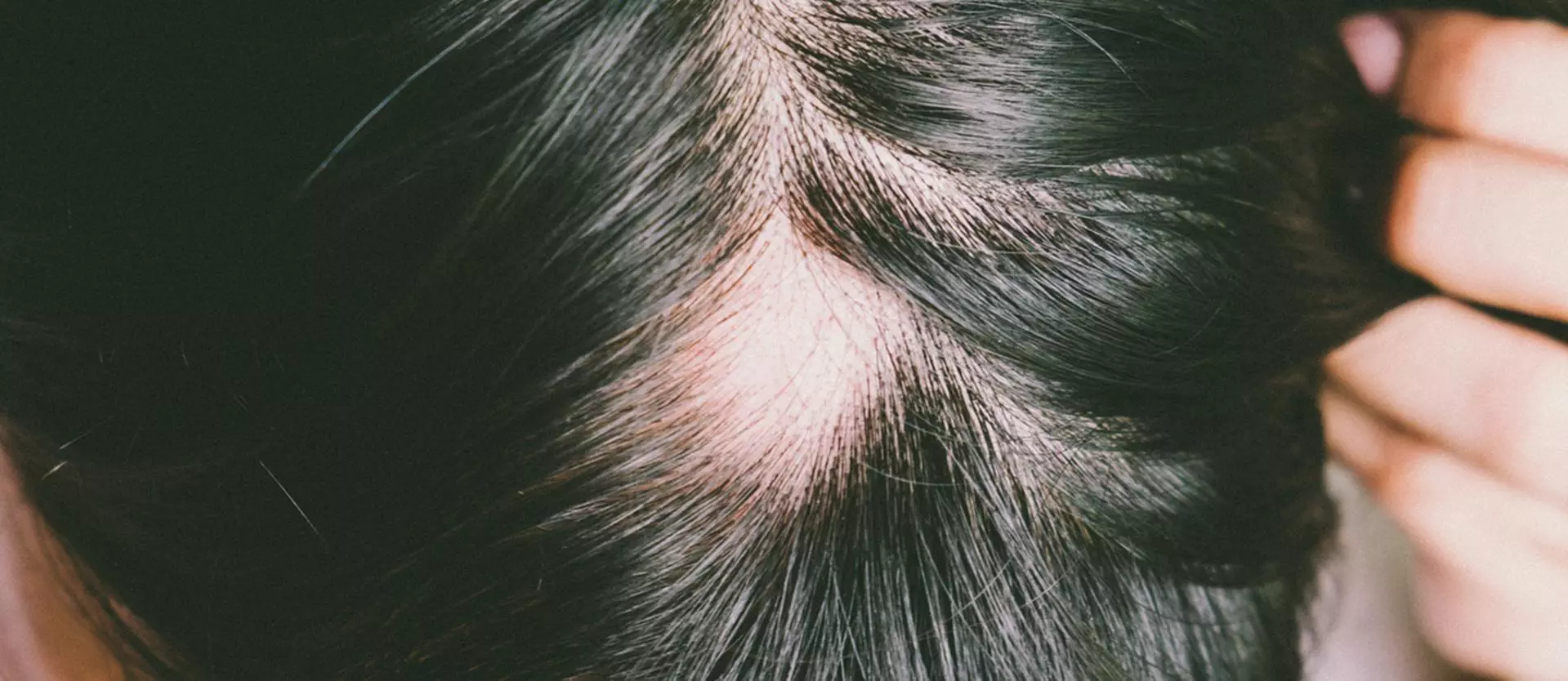 Facts About Alopecia Areata 
