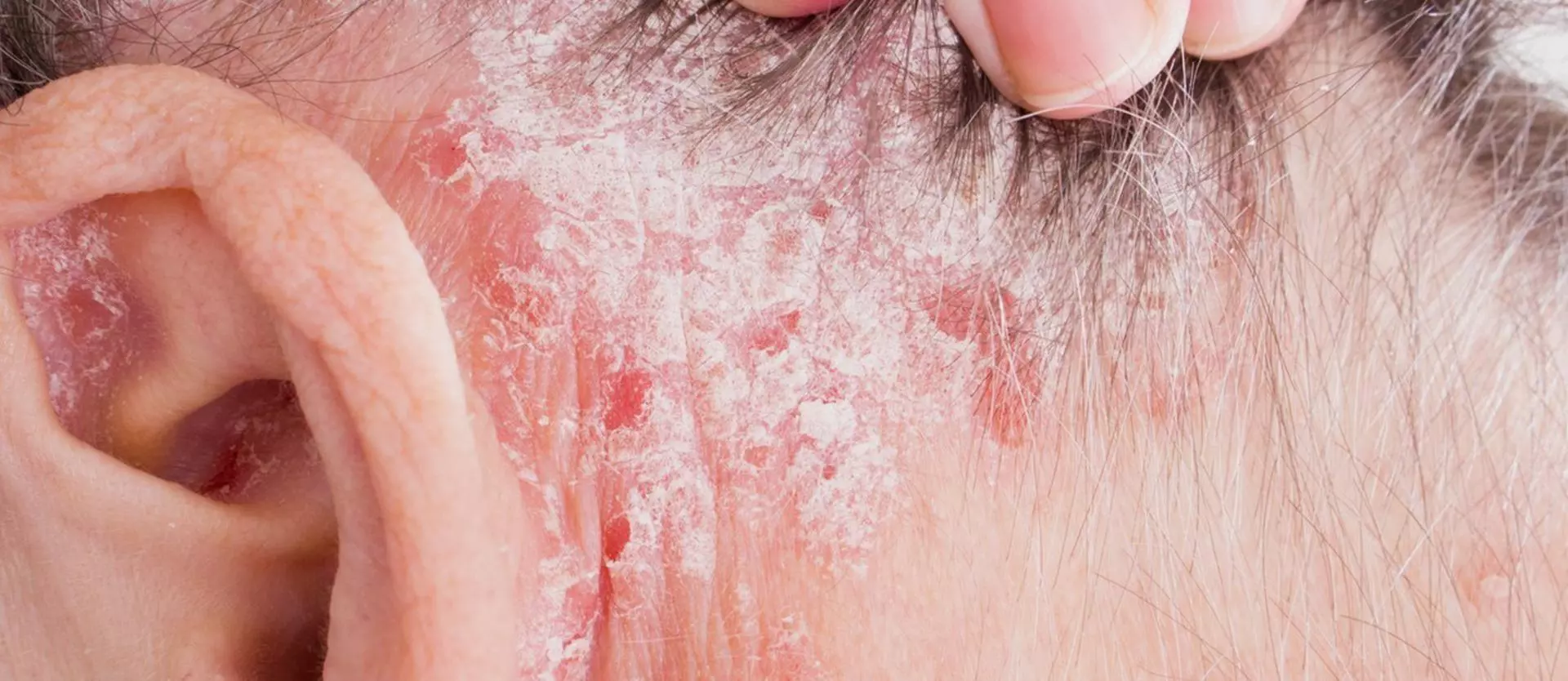 How to Treat Psoriasis of the Scalp  