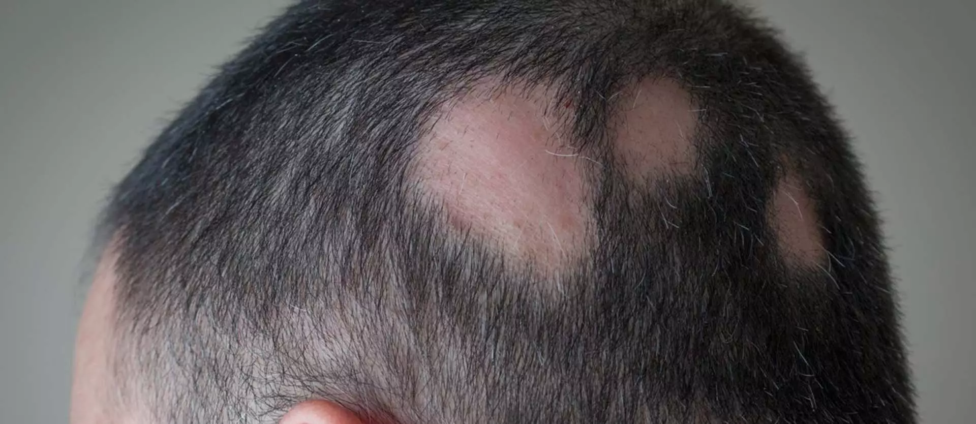 Understanding Alopecia Areata 