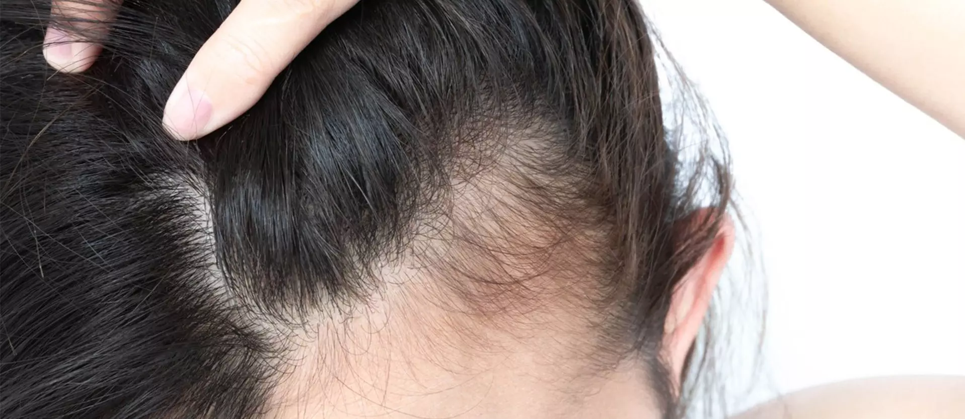 The Differences Between Frontal Fibrosing Alopecia and Traction Alopecia