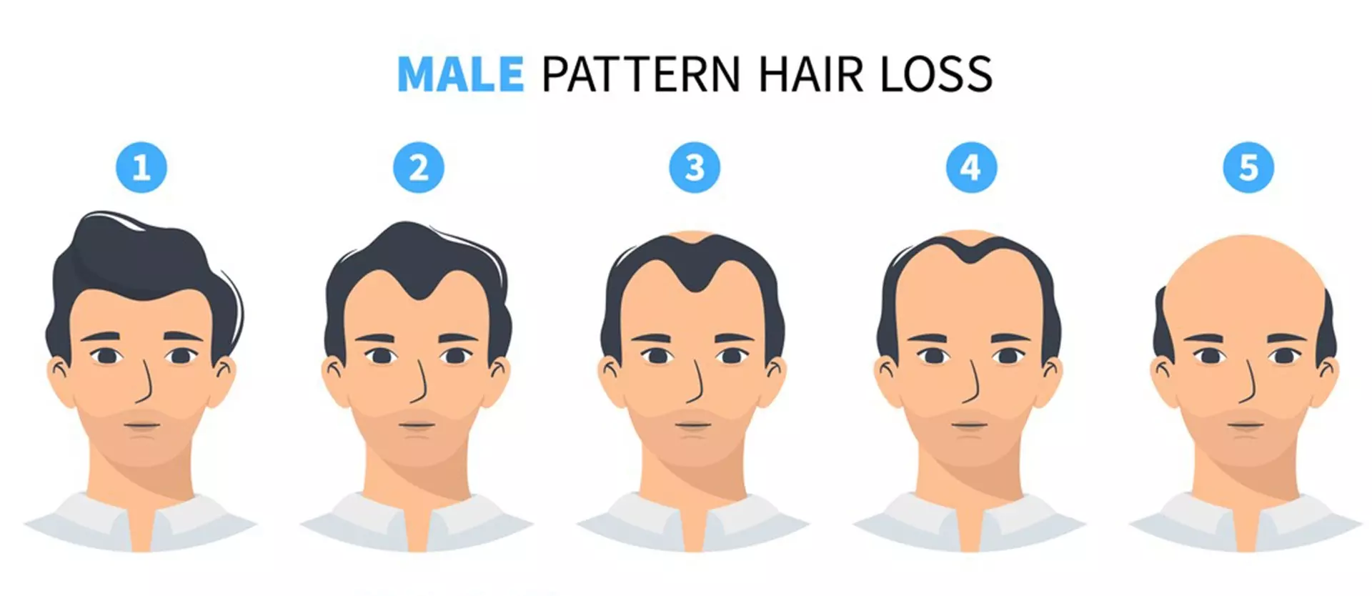 What is Androgenetic Alopecia?