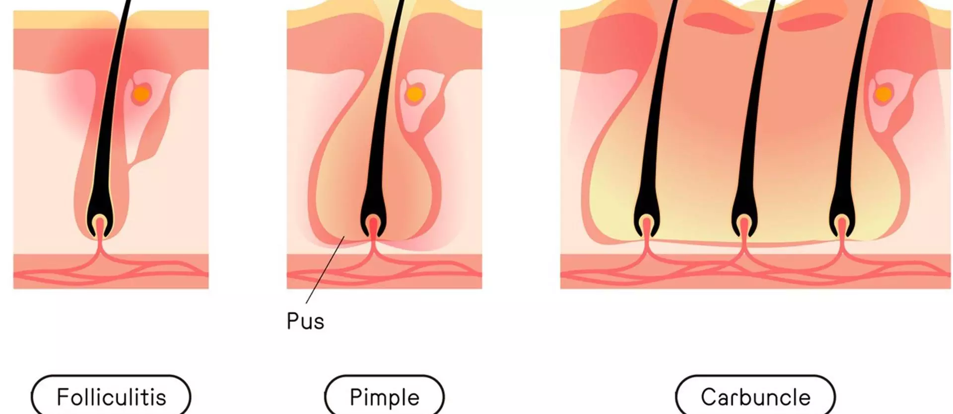 What Is Folliculitis Decalvans?