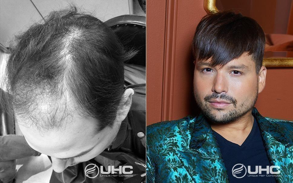 Hair Restoration NYC Before & After Photos UHC