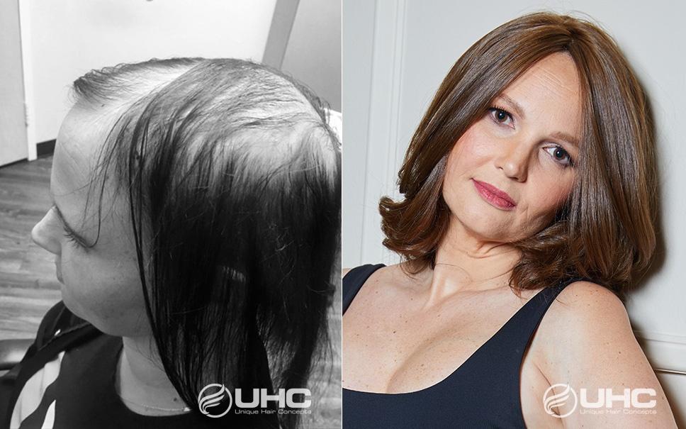 UHC Before & After Hair Restoration Photo Gallery