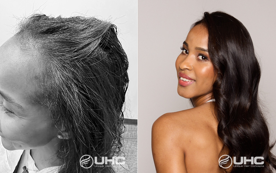 UHC Before & After Hair Restoration Photo Gallery UHC Before & After Hair Restoration Photo Gallery
